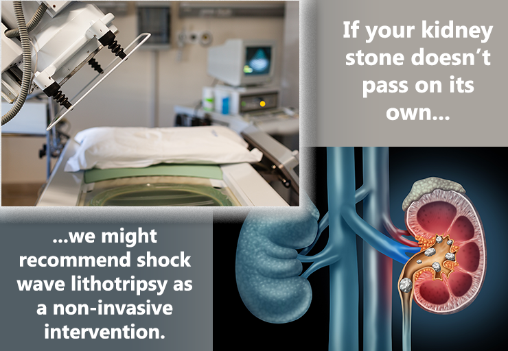 If your kidney stone doesn't pass on its own, we might recommend shock wave lithotripsy as a non-invasive intervention. Accompanying issustration of kidney with stones and photo of shock wave lithotripsy machine.