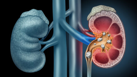 illustrated medical diagram cross section showing kidney stones in kidneys