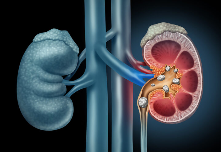 illustrated medical diagram cross section showing kidney stones in kidneys
