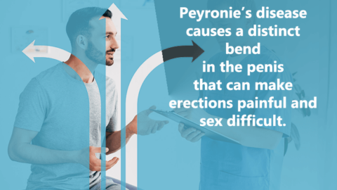 Peyronie's disease causes a distinct bend in the penis that can make erections painful and sex difficult.