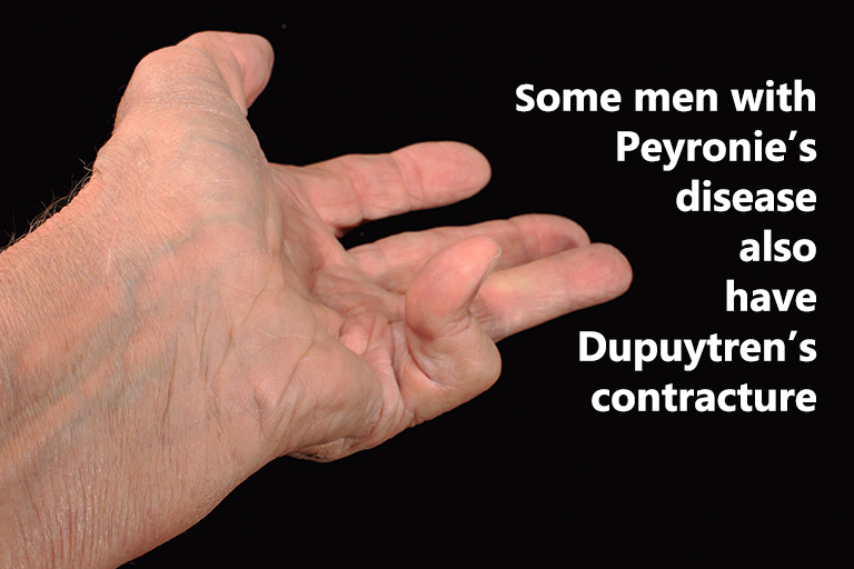 Some men with Peyronie's disease also have Dupuytren's contracture.