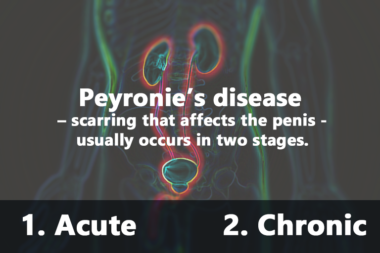 Peyronie's disease - scarring that affects the penis - usually occurs in two stages: acute and chronic.