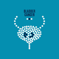 an illustration indicating bladder cancer