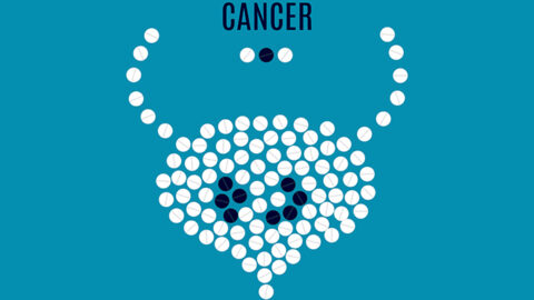 an illustration indicating bladder cancer