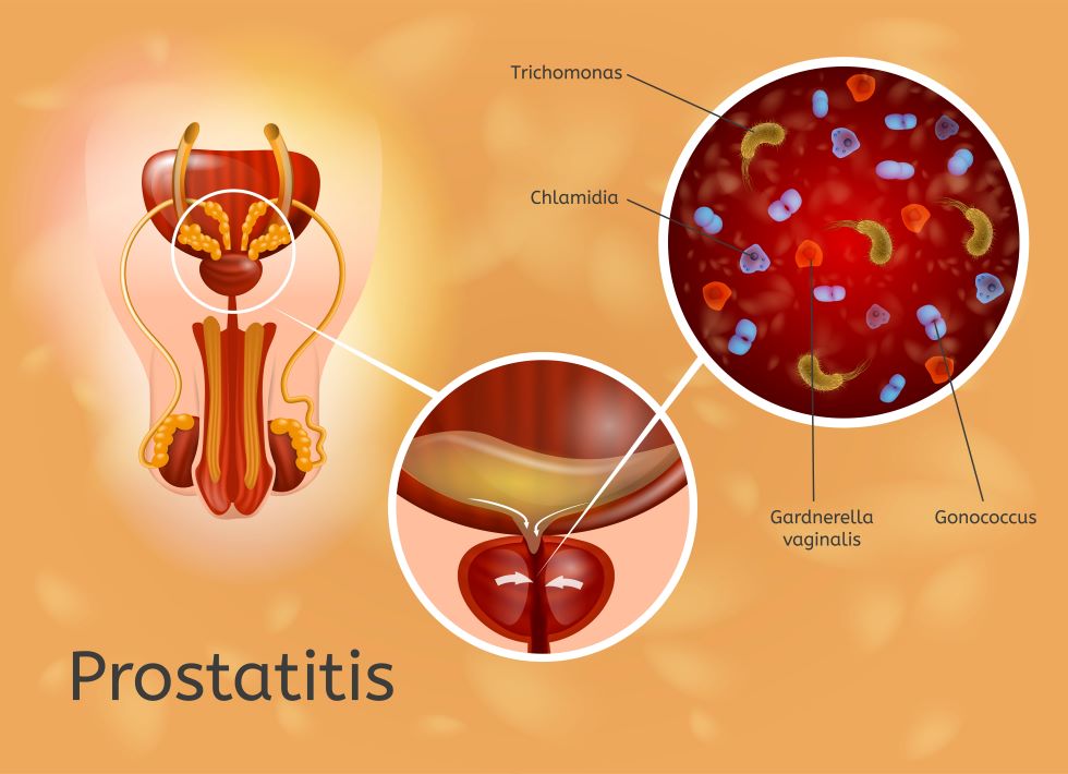 diagram showing where bacterial would cause inflamation of the prostate, with examples of the different bacteria enlarged