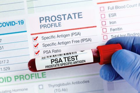 A test tube filled with blood over top of a paper showing prostate profile
