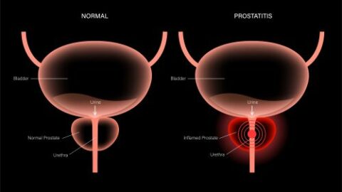 Diagram showing a normal prostate verses on that is red with a bullseye radiating outward