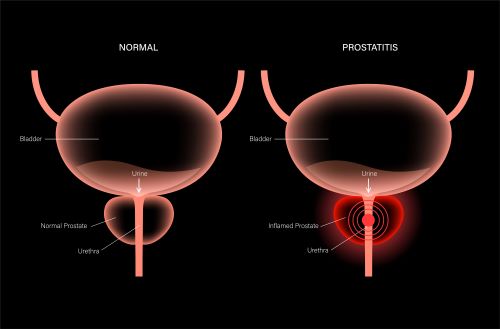 Diagram showing a normal prostate verses on that is red with a bullseye radiating outward