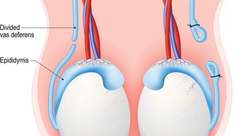 Illustration of testes, epididymides, and vasa deferentia. One vas deferens has been cut. The other vas deferens has been cut and tied closed.