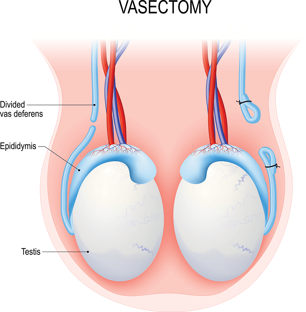 Illustration of testes, epididymides, and vasa deferentia. One vas deferens has been cut. The other vas deferens has been cut and tied closed.