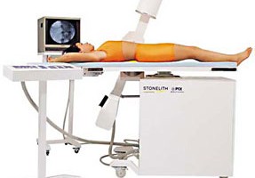 diagram of a patient lying on table under Extracorporeal Shockwave Lithotripsy Machine