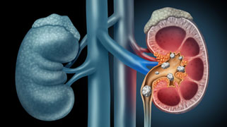 Medical diagram of the kidneys cut away to illustrate kidney stones