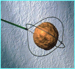 Stone captured in a small basket that is placed through the ureteroscope camera.