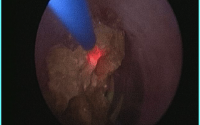 Lasering (laser fiber in blue) of a stone (yellow) done through the ureteroscope.