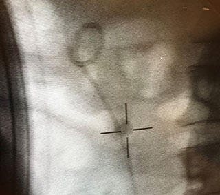 Medical scan image showing the targeting of the Stone During Soundwave Lithotripsy