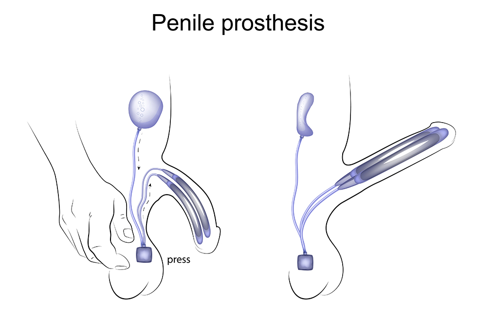 Illustration of a penile prosthesis