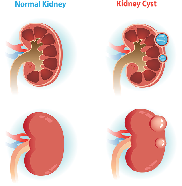 Illustration showing normal kidney and kidney cyst
