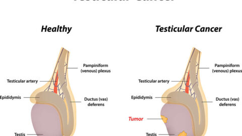Illustration of testicular cancer